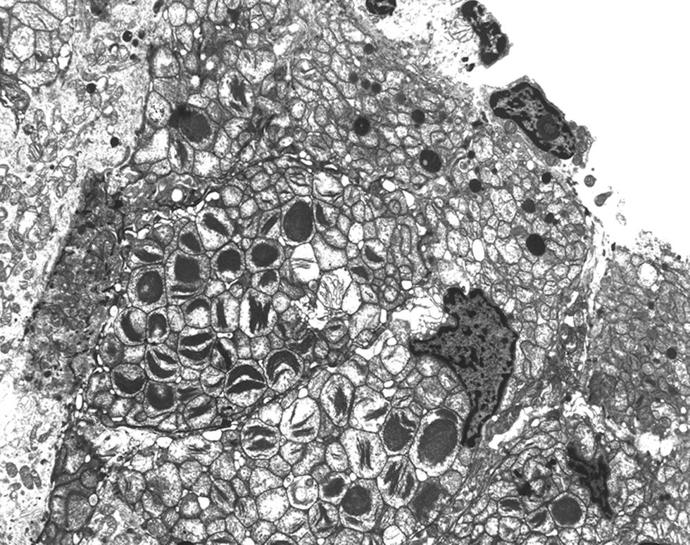 Warthin's tumour - paracrystalline inclusions